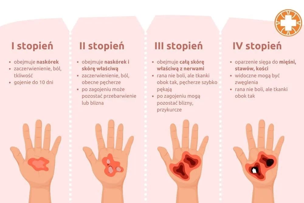 Oparzenia jak postępować: skuteczne metody leczenia i pierwsza pomoc